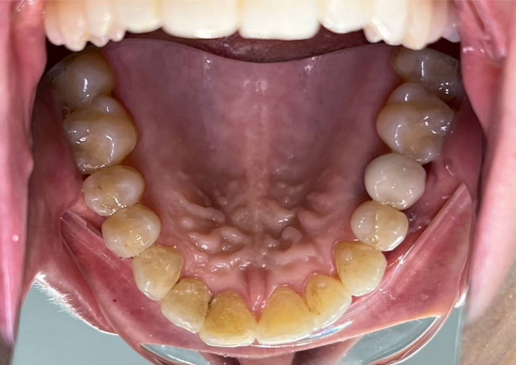 Crowding Upper Occlusal After
