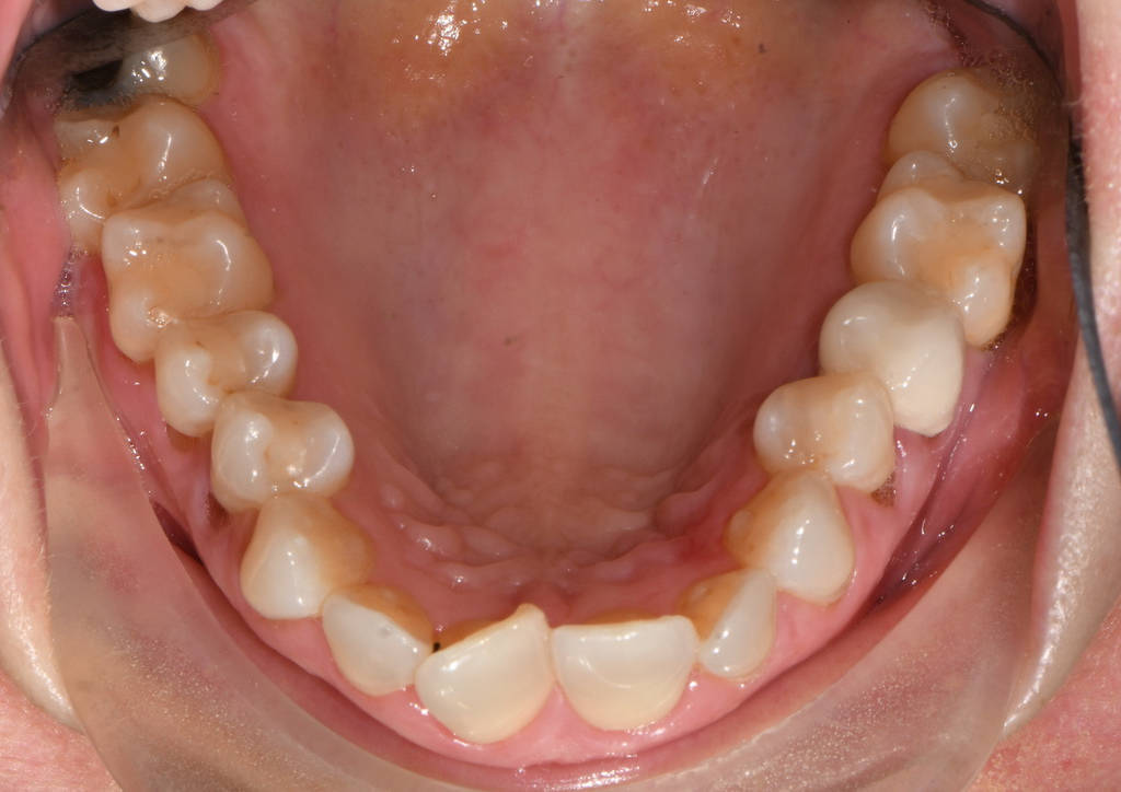 Crowding Upper Occlusal Before