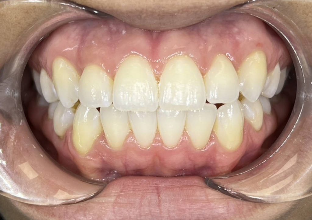 after invisalign treatment